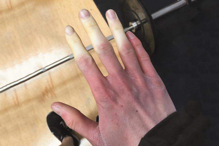 Fenomena Raynaud: Penyebab, Gejala, Diagnosis, Pengobatan