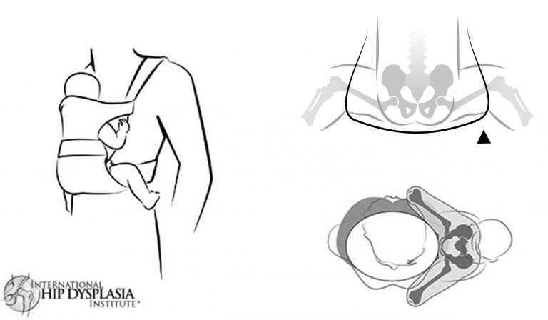 ilustrasi tulang bayi dengan M-Shape (hipdysplasia.com)