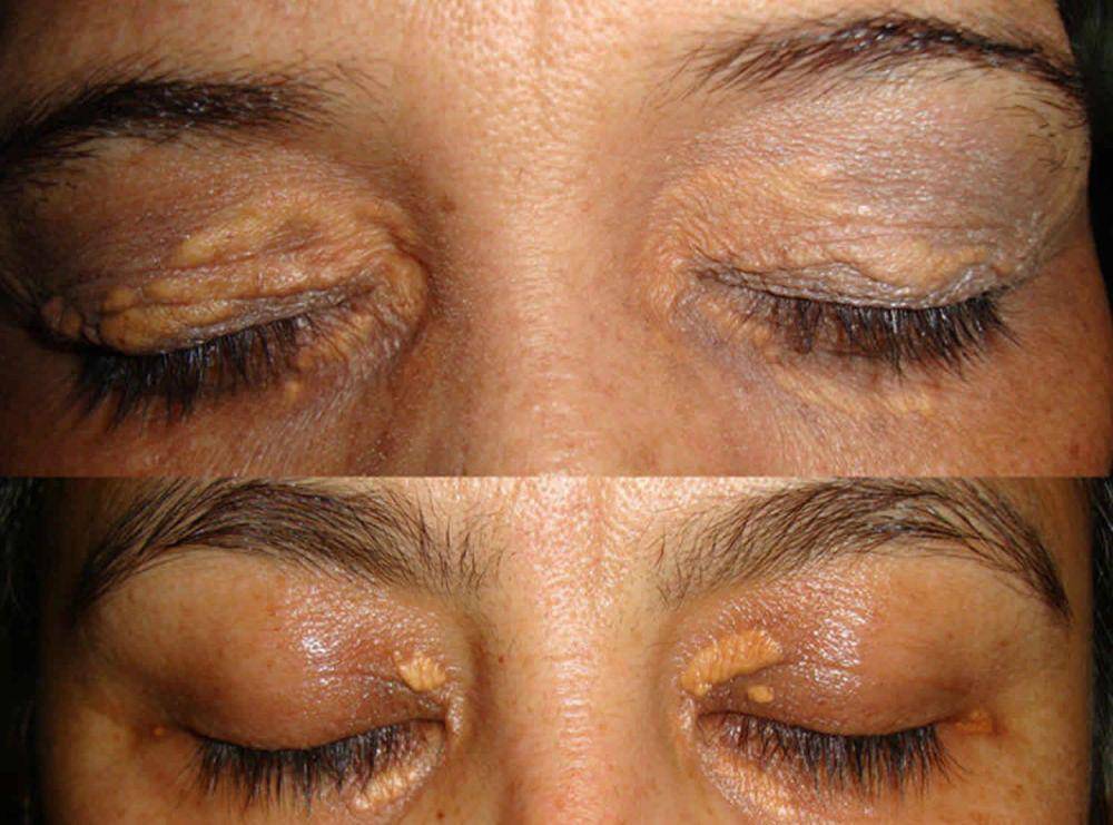 Xanthoma yang merupakan akumulasi kolesterol di kulit kelopak mata. (healthjade.com)