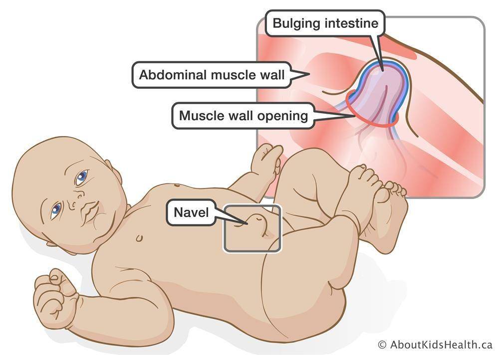 ilustrasi hernia umbilikalis pada bayi (aboutkidshealth.ca)