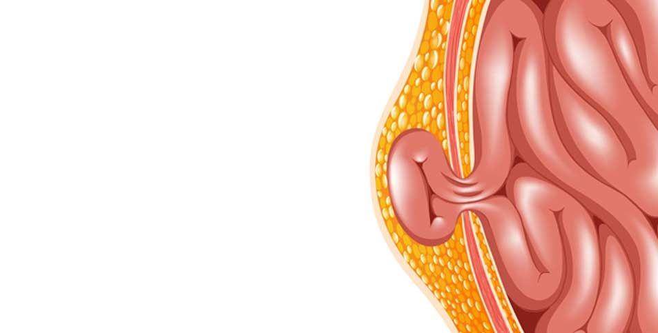ilustrasi hernia umbilikalis (riversideweightlosssurgery.com)