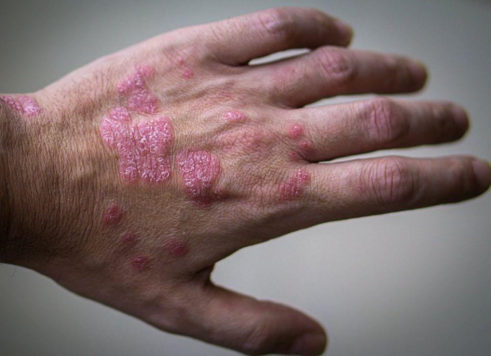 Psoriasis, Vitiligo, dan Urtikaria Meningkat selama Pandemik