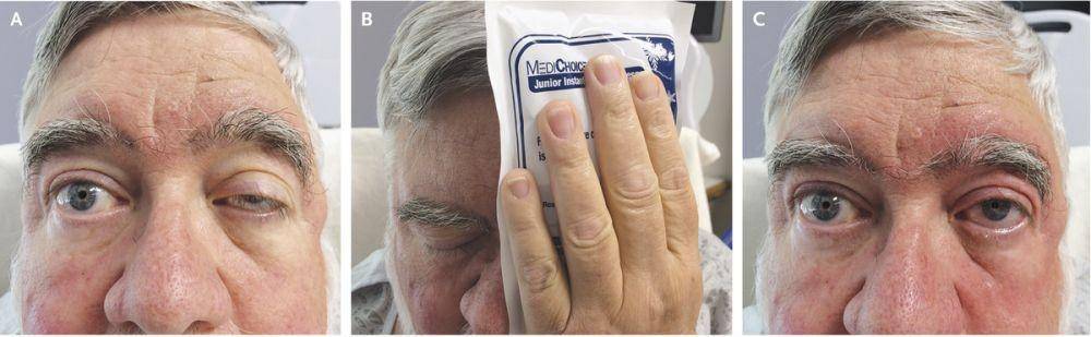 Ice pack test untuk diagnosis myasthenia gravis. (nejm.org/Wendy W. Liu, M.D., Ph.D., and Adam Chen, M.D.)