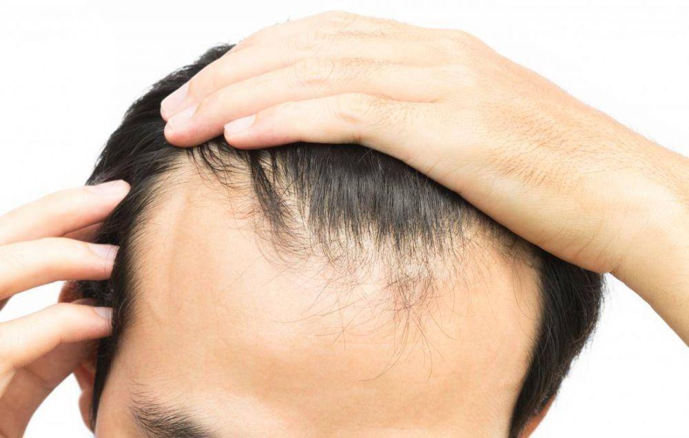 Minoxidil Topikal: Manfaat, Peringatan, Dosis, Efek Samping