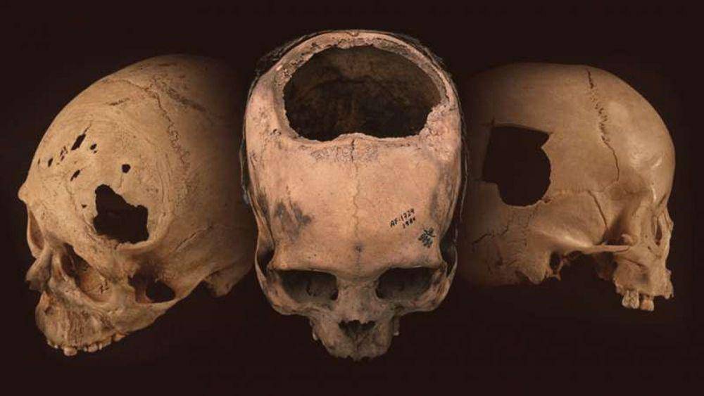 bukti trepanasi pada masyarakat zaman dulu (phys.org)