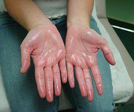 ilustrasi hiperhidrosis di telapak tangan (commons.wikimedia.org/Agarmanchis80)