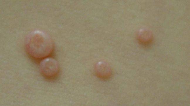 ilustrasi molluscum contagiosum (healthline.com)