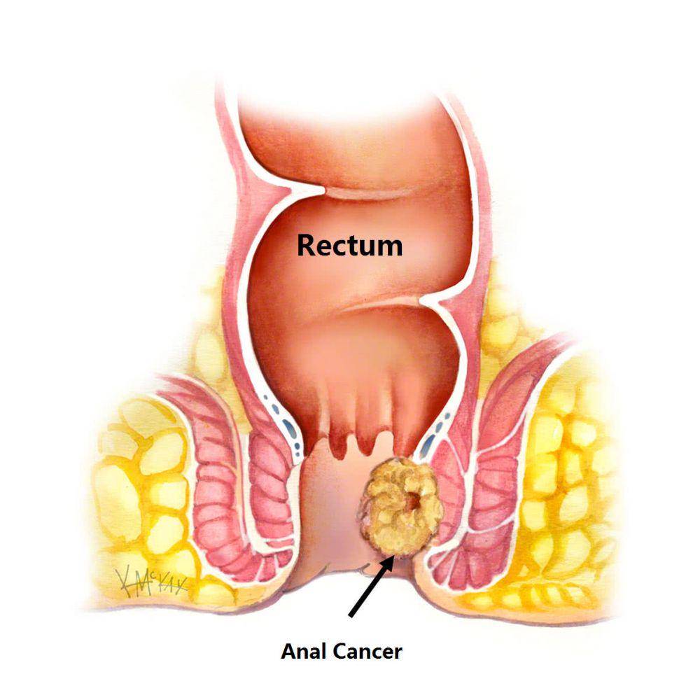 ilustrasi kanker anus (colorectalsurgeonssydney.com.au)