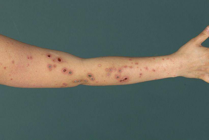 ilustrasi prurigo nodularis (derm.theclinics.com/Claudia Zeidler, Gil Yosipovitch, Sonja Ständer)