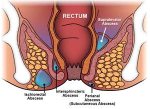 ilustrasi abses anus (fascrs.org)