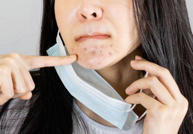 Kelembapan dari Mulut dan Hidung Bisa Memicu Maskne