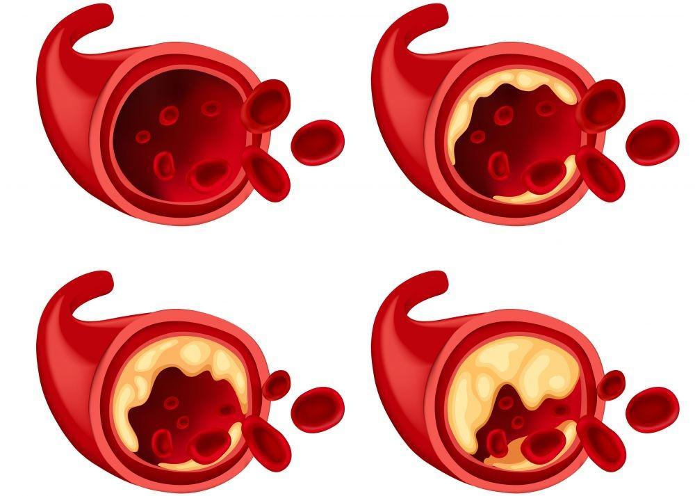Trombosis Arteri: Gejala, Penyebab, Diagnosis, Pengobatan