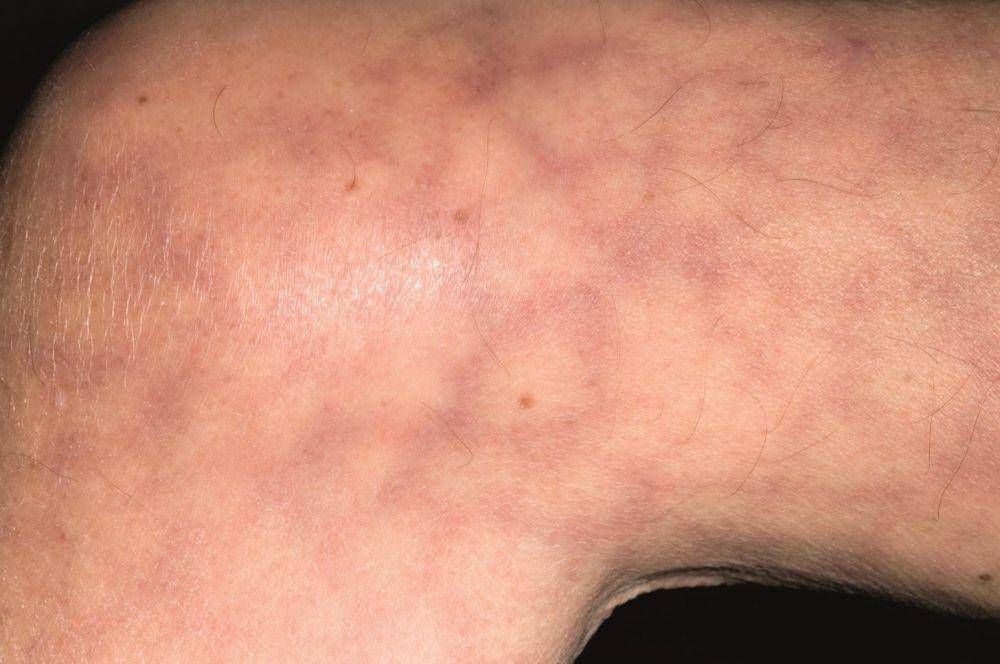 ilustrasi sindrom antifosfolipid (pharmaceutical-journal.com)