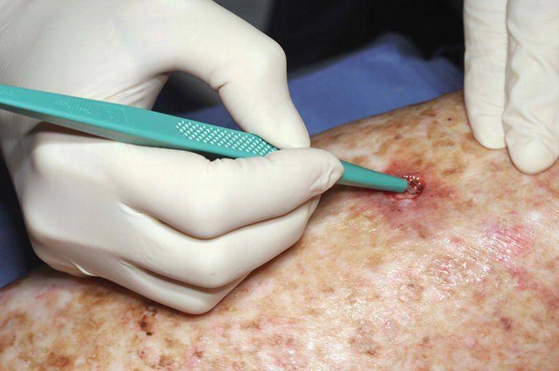 ilustrasi prosedur electrodesiccation and curettage (link.springer.com/Skin Cancer Management/Gloria F. Graham)