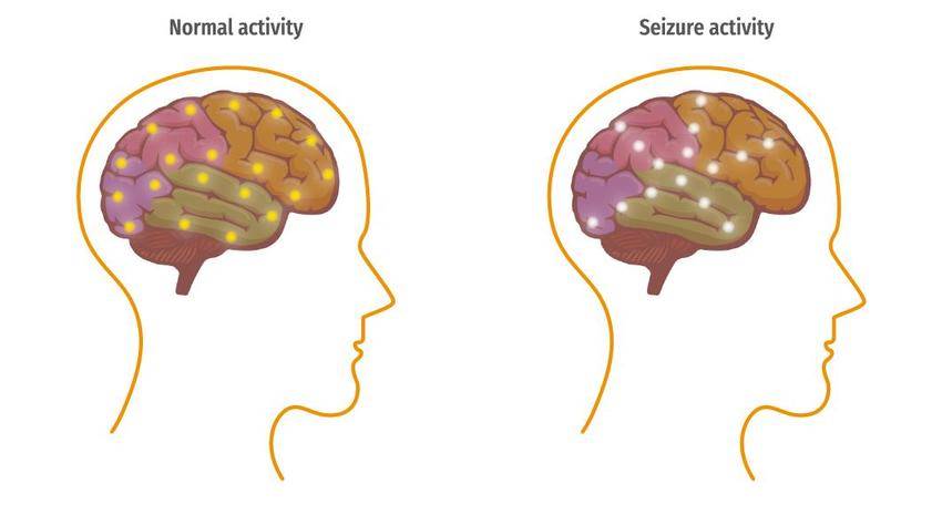 ilustrasi otak normal vs otak dengan aktivitas kejang (researchgate.net)