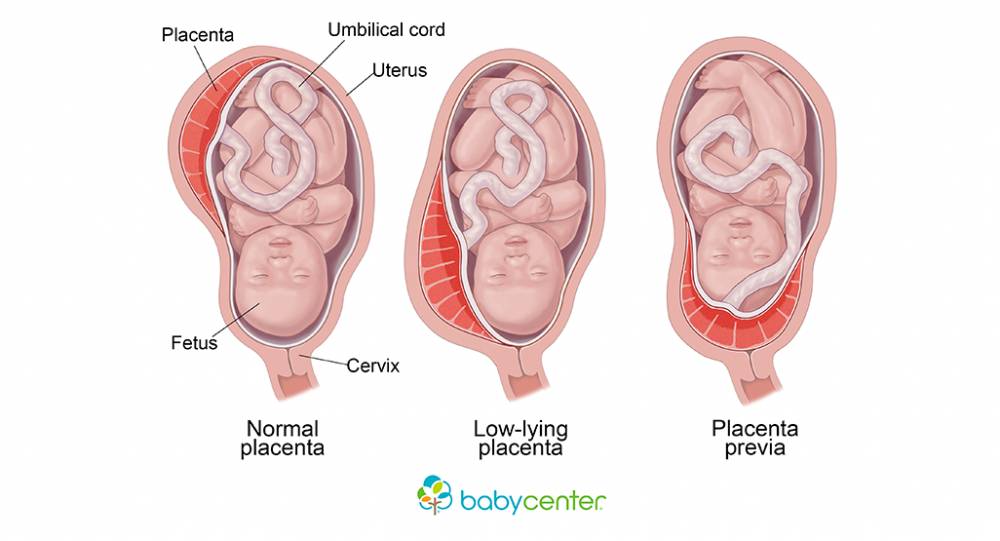 Ilustrasi plasenta previa dalam operasi caesar (babycenter.com)