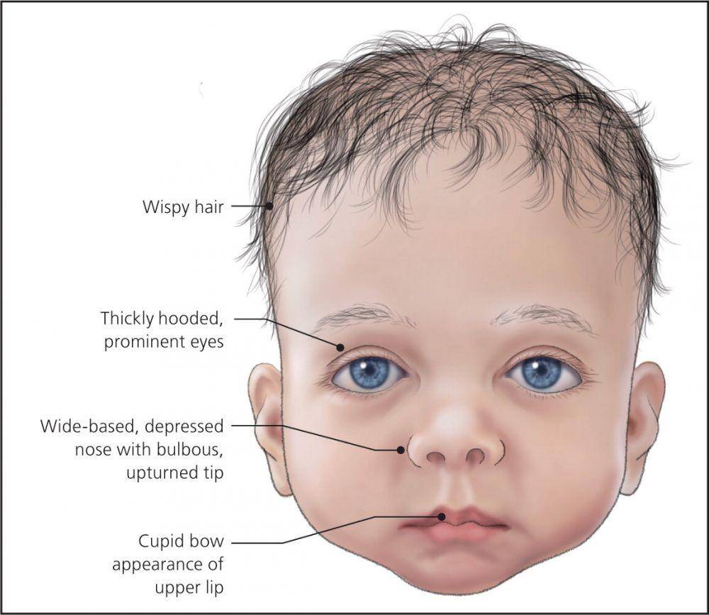 ilustrasi sindrom Noonan (aafp.org)