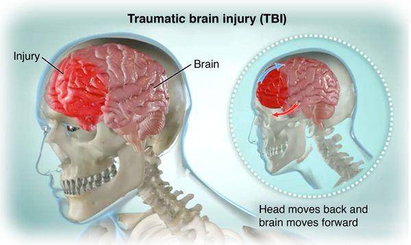 ilustrasi trauma otak penyebab dystonia (saintlukeskc.org)