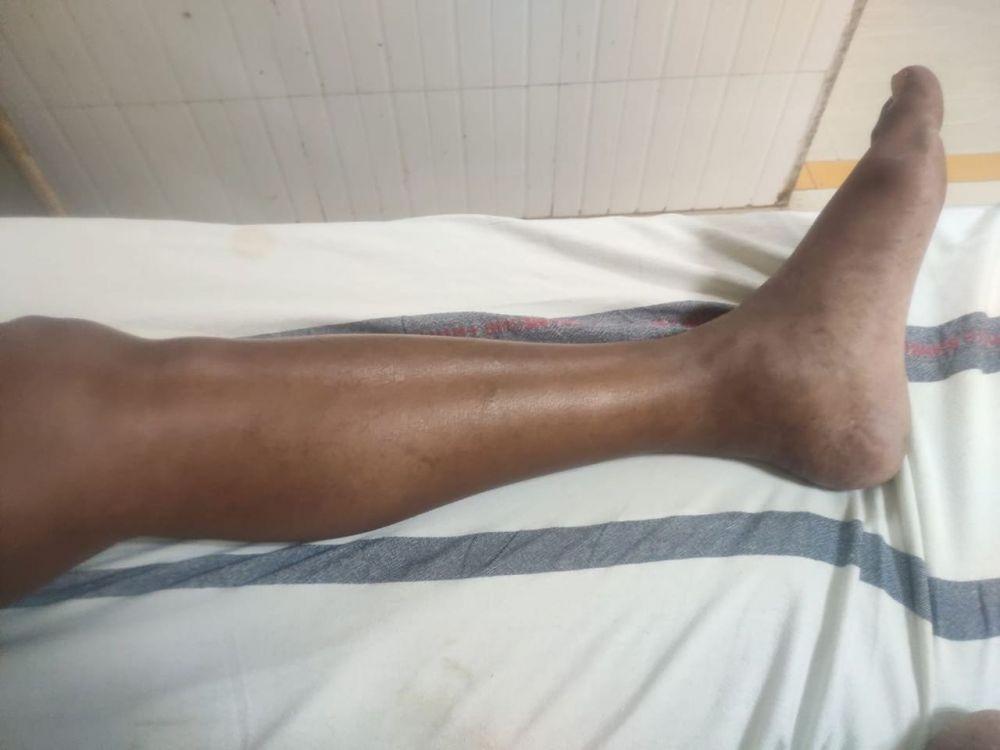 Deep Vein Thrombosis: Gejala, Penyebab, Pengobatan, Pencegahan