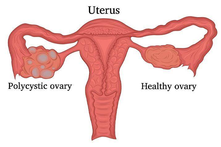 ilustrasi polycystic ovary sindrome atau sindrom ovarium polikistik (parkwayeast.com.sg)