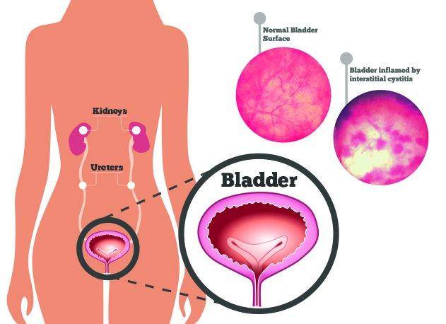 ilustrasi cystitis interstisial (obgyn.co.nz)