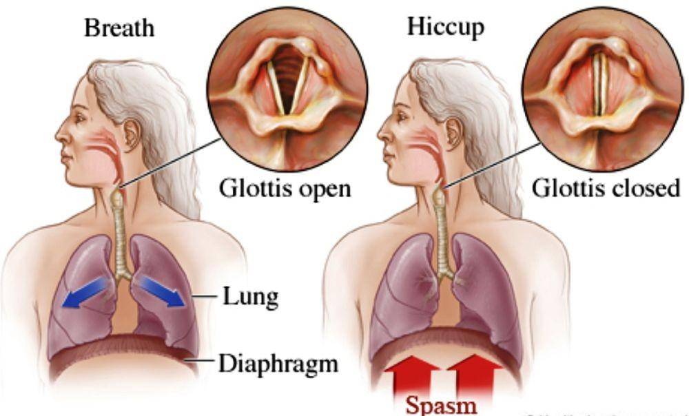 ilustrasi penyebab cegukan (healthjade.net)