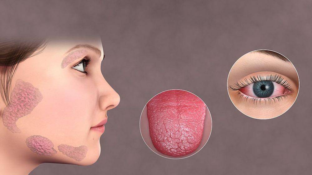 ilustrasi gejala pada sindrom Sjogren (scientificanimations.com)