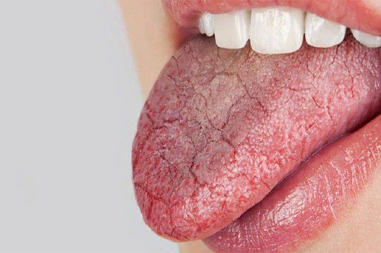 Sindrom Sjogren: Penyebab, Gejala, Komplikasi, dan Pengobatan