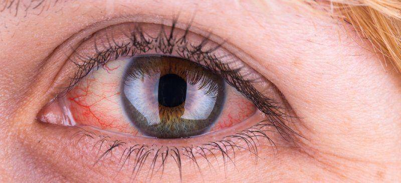 ilustrasi mata kering pada sindrom Sjogren (eyecenterofvirginia.com)