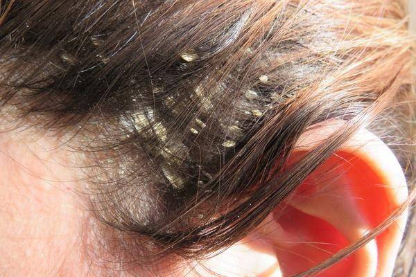 Ilustrasi seborrheic dermatitis salah satu jenis xerosis (balmonds.co.uk)