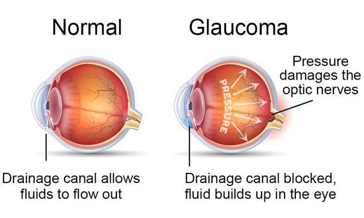 Glaukoma akut adalah kondisi ketika cairan menumpuk pada mata hingga dapat menimbulkan tekanan yang merusak saraf mata. (gafacom.com)