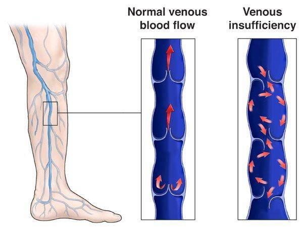 ilustrasi chronic venous insufficiency atau insufisiensi vena kronis (rwjbh.org)