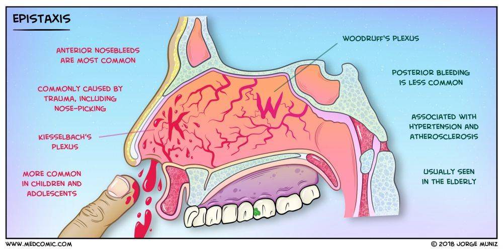 ilustrasi jenis mimisan atau epistaksis (aomcfoamed.com)