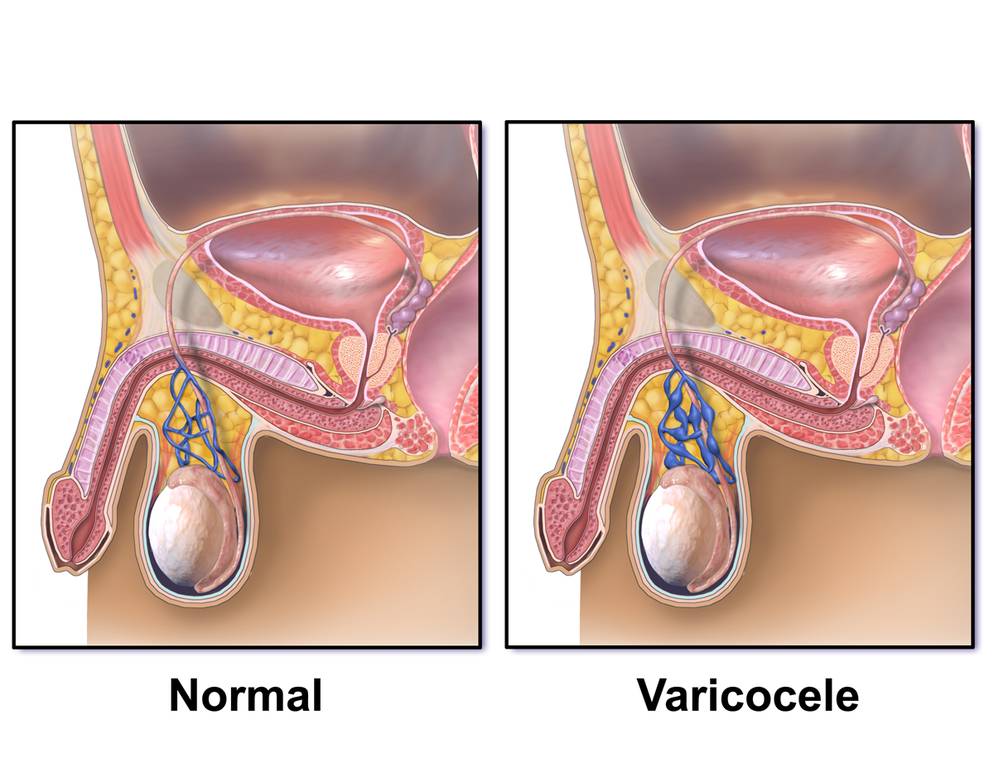 ilustrasi varikokel (commons.wikimedia.org/BruceBlaus)