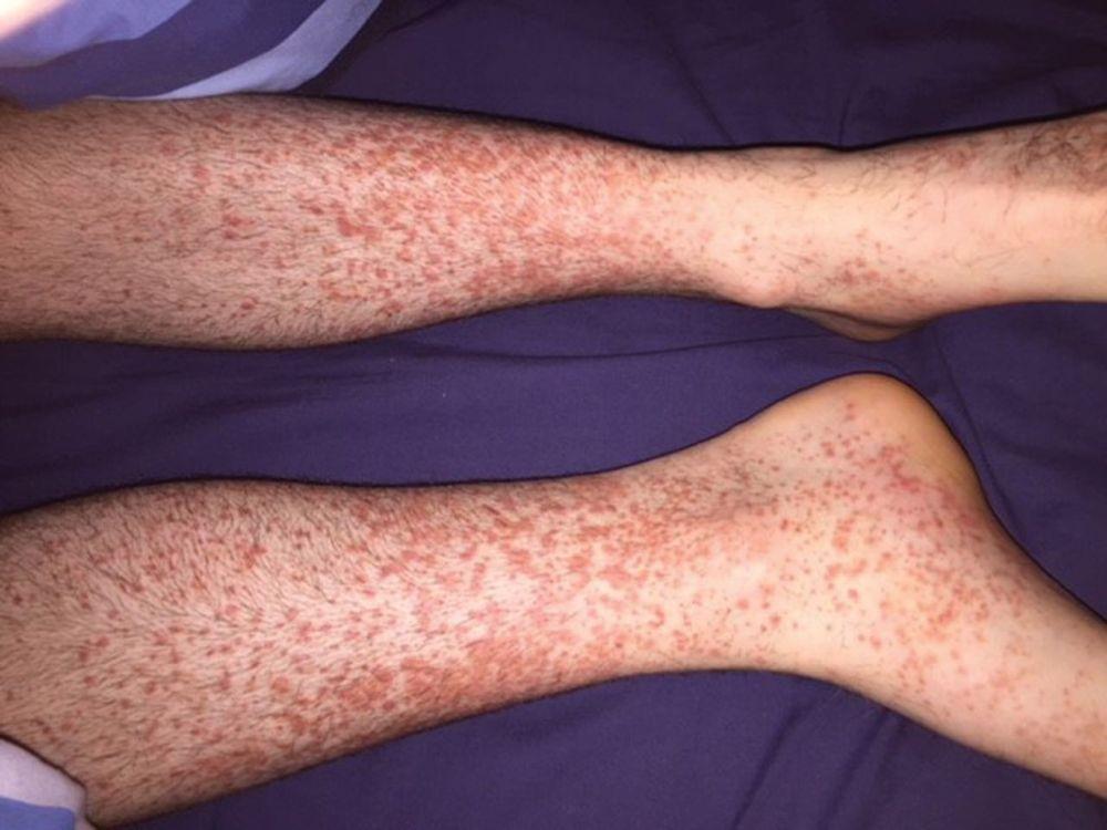 Henoch-Schonlein Purpura: Gejala, Penyebab, Diagnosis, Pengobatan