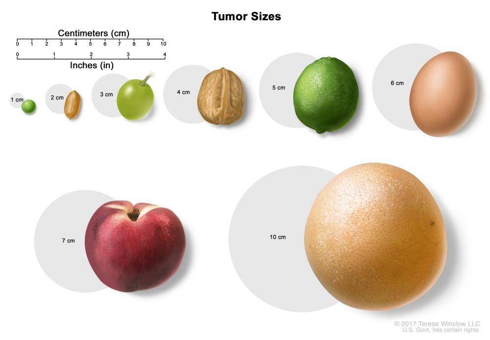 Ilustrasi ukuran tumor cholangiocarcinoma (cholangiocarcinoma.org)