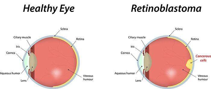ilustrasi retinoblastoma (aoa.org)