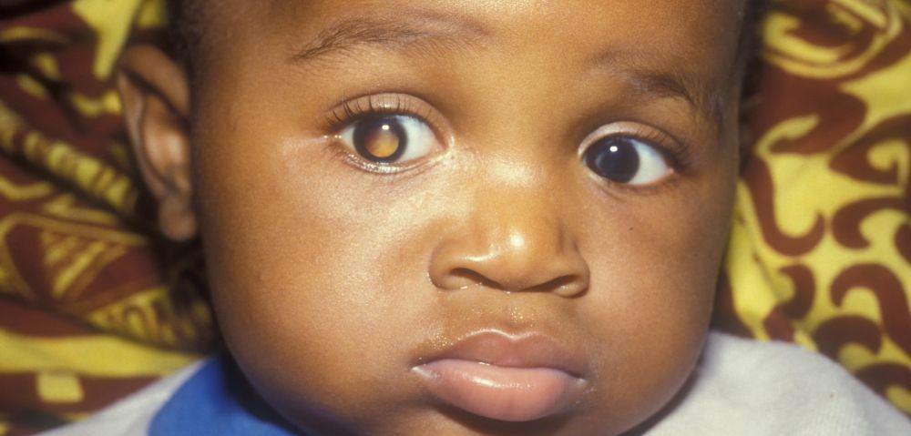 Retinoblastoma: Penyebab, Gejala, Komplikasi, dan Pengobatan