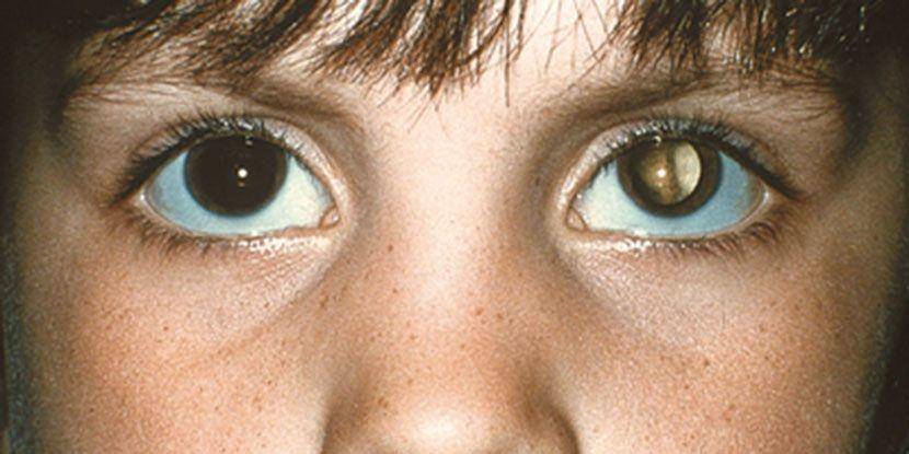ilustrasi retinoblastoma (aao.org)