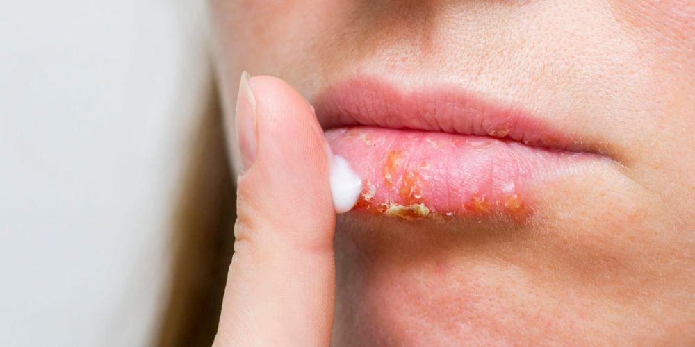 5 Penyebab Luka di Bibir, Mulai dari Alergi sampai Herpes