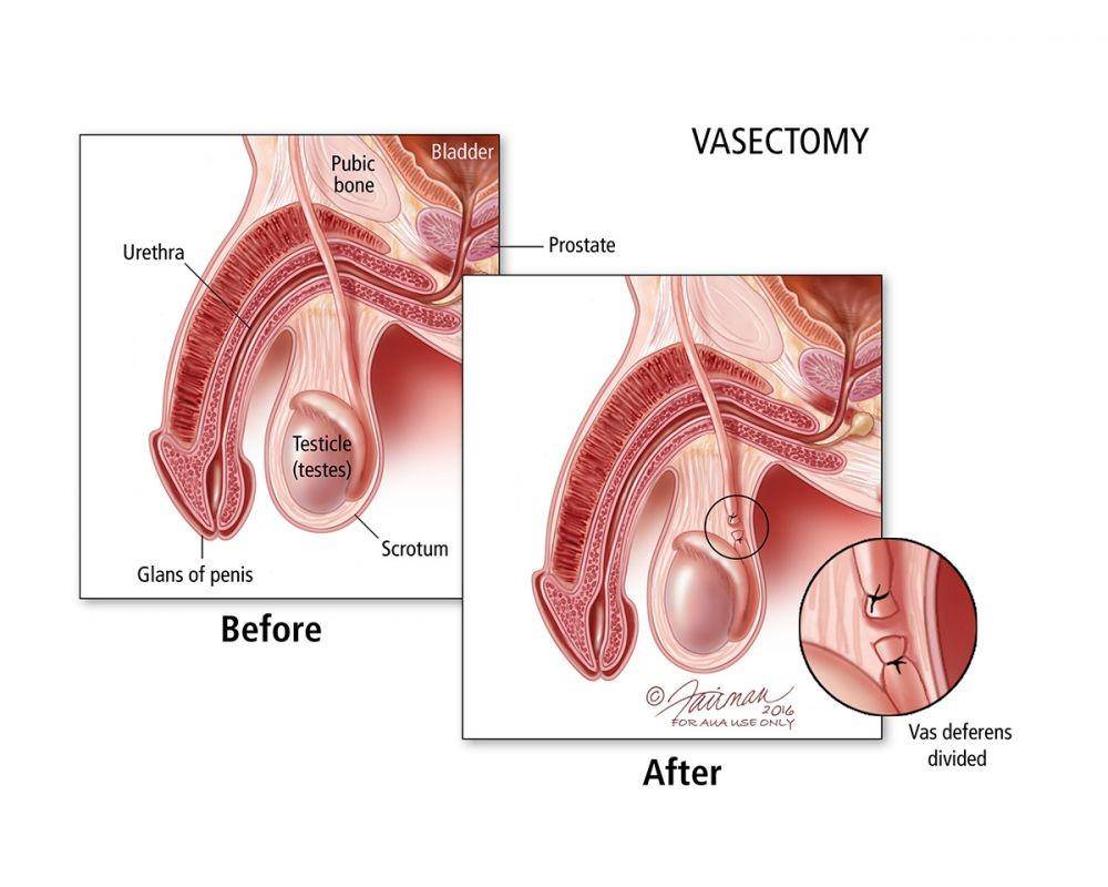 ilustrasi vasektomi (urologyhealth.org)