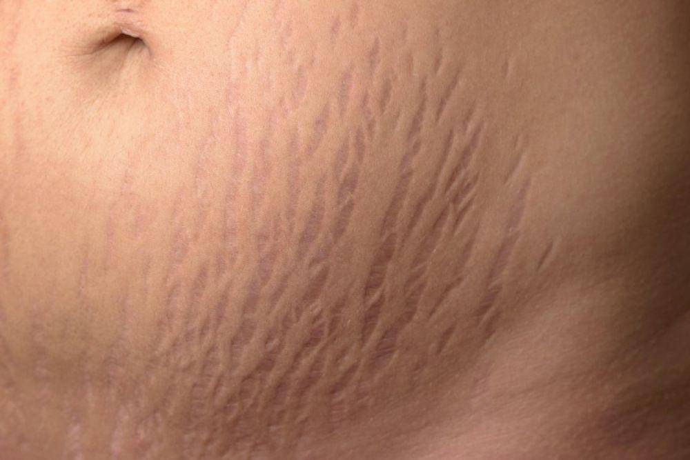 ilustrasi stretch mark (nhs.uk)
