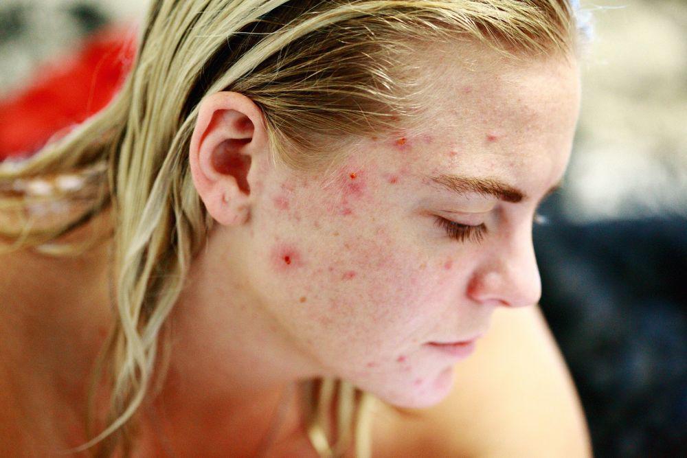 Hormonal Acne (Jerawat Hormonal): Penyebab, Gejala, Pengobatan