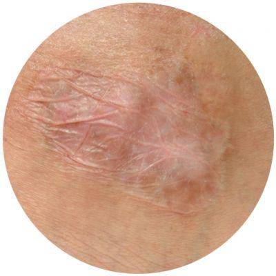 ilustrasi jaringan parut kontraktur (artofdermatology.com)