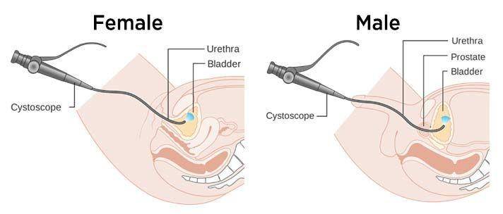 ilustrasi sistoskopi atau cystoscopy pada laki-laki dan perempuan untuk diagnosis cystitis (urologysanantonio.com)