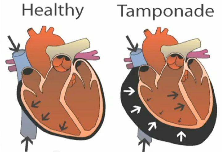 ilustrasi tamponade jantung atau cardiac tamponade (firstaidforfree.com)