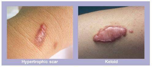 ilustrasi jaringan parut hipertrofik dan bedanya dengan keloid (specialty.mims.com)