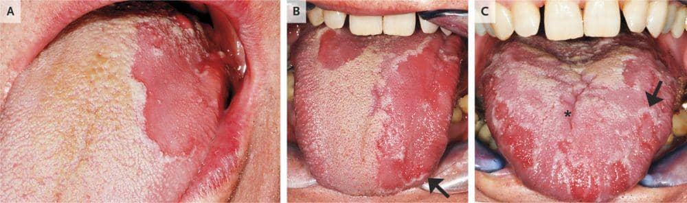 ilustrasi lidah geografis (nejm.org/Elena Varoni, D.D.S., Ph.D., Sem Decani, D.D.S.)