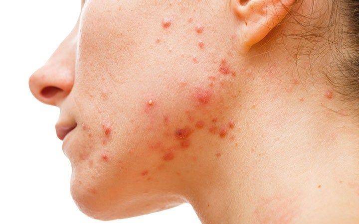 ilustrasi hormonal acne atau jerawat acne pada orang dewasa (skinkraft.com)