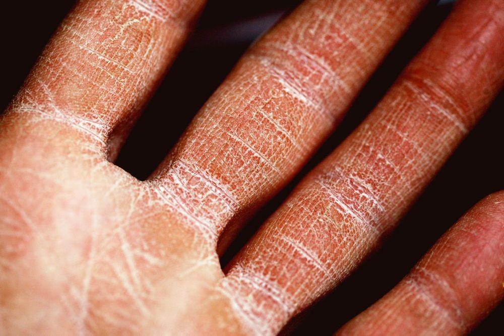 Xerosis (Kulit Kering): Penyebab, Gejala, Pengobatan, Pencegahan